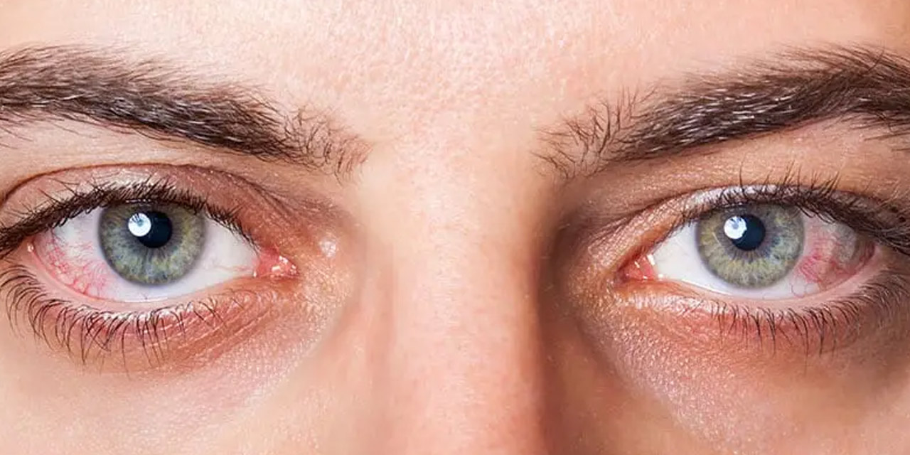 Göz tansiyonu nedir? Göz tansiyonu hakkında bilinmesi gerekenler