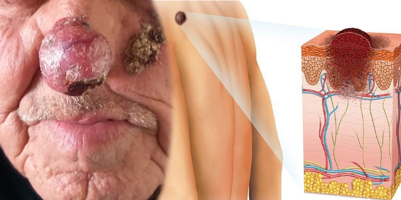 Kırıkkale’de cilt kanserine karşı erken teşhis kampanyası!