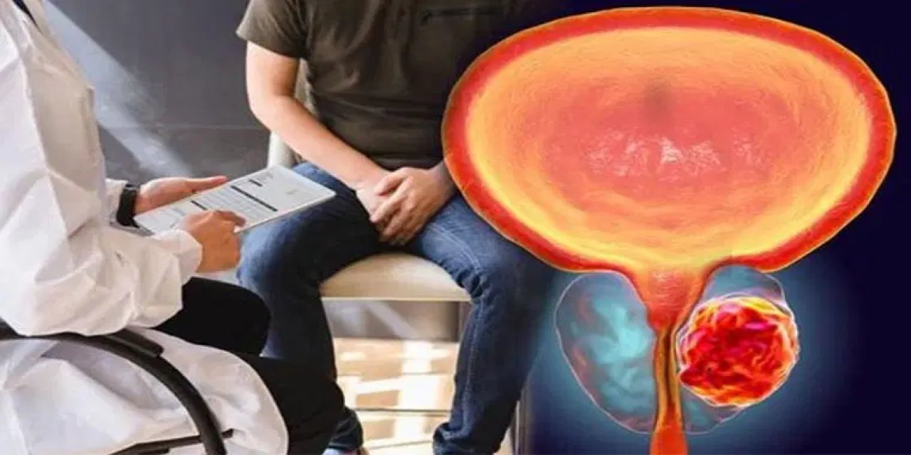 Prostat kanseri, erkeklerde en çok görülen ikinci kanser türüdür