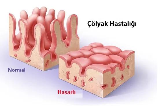 colyak.webp